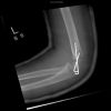 Displaced fracture of the lateral epicondyle of the humerus - post K-wire Fixation - Lateral view (4)