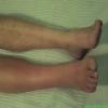 Complex regional pain syndrome (reflex sympathetic dystrophy) lower leg - note mottled, shiny skin of right leg