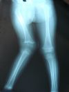 Genu valgum (Rt) due to growth arrest of femoral lateral condyle