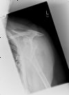 Fracture Dislocation (Anterior) of Left Shoulder - Lateral View (2)