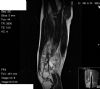 MRI showing a large osteosarcoma right midshaft/distal femur requiring above knee amputation