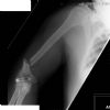 Distal third humeral fracture. Holstein-Lewis type. AP radiograph