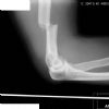 Distal third humeral fracture. Holstein-Lewis type. Lateral radiograph