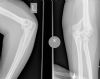 comminuted intra-articular fracture of distal humerus - C3