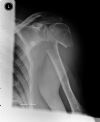 Proximal humeral fracture - axial view (1)