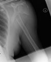 Proximal humeral fracture - AP view (2)