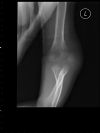 Displaced  fracture  of  the  lateral  epicondyle  of  the  humerus - AP view (1)