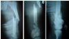 Comminuted fx of Knee & femur + fx of base of neck