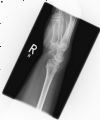 Fracture of the Distal radius with avulsion of the styloid process  of the ulna - Lateral view (2)