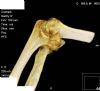 Distal humerus intra-articular fracture with large capitellar fragment and radial head fracture. CT 3D reconstruction 4 (Dushan Atkinson)
