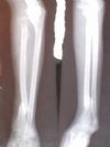 fracture of L/3 radius with dislocation SRUJ, DRUJ and fracture lower end humerus