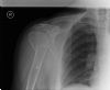 3 part fracture right neck of humerus - AP view (2) (A. Gupta)