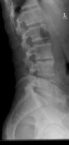 L3/4 lumbar Disciitis. Lateral radiograph. Courtesy of www.healthengine.com.au