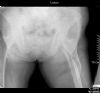 Oblique subtrochanteric femoral fracture