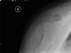 3 part fracture right neck of humerus - axial view (1) (A. Gupta)
