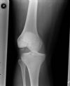 Dislocated Right Knee - AP (1)