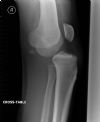 Dislocated Right Knee - Lateral view (2)