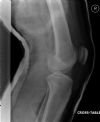 Dislocated Right Knee - Lateral view post reduction (3)