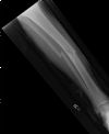 Displaced, comminuted fractures  of the mid shaft of the tibia and fibular - AP view (1)