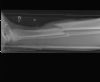 Displaced, comminuted fractures  of the mid shaft of the tibia and fibular - Lateral view (2)
