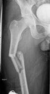 Comminuted and displaced fracture of the proximal right femur - AP View (1)