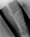 Comminuted and displaced fracture of the proximal right femur - post op IM Nail - AP View (2)