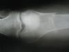 Pathological Supracondylar fracture in a 35 yr old 
