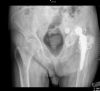 Chronic THR dislocation. 
False acetabulum. 
Cup penetration into pelvis.