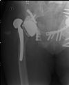 right captive cup hip replacement. Dislocated!