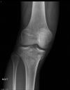 Tibial plateau fracture. Variant of Schatzker 5. Courtesy of www.healthengine.com.au