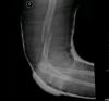 Distal third humeral fracture lateral view