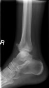 Bimalleolar Ankle Fracture 2/6:: Pre-reduction. Lateral radiograph
