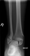 Bimalleolar Ankle Fracture 1/6:: Pre-reduction. AP radiograph