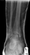 Bimalleolar Ankle Fracture 3/6:: Post-reduction. AP radiograph