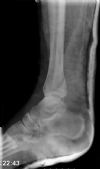 Bimalleolar Ankle Fracture 5/6:: Post-reduction. Lateral View radiograph