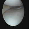 Posterior horn tear post excision