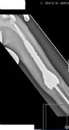 AP left femur showing non-invasive growing femoral replacement.

History: 9 yr male with osteosarcoma of distal femur.