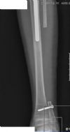 AP tibia and fibula showing absent fibula after removal for strut graft reconstruction of peri-prosthetic fracture of non-invasive growing femoral replacement.

History: 9 yr male with osteosarcoma of distal femur.