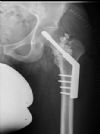 DHS fixation and cementation following curettage of intramedullary lesion 