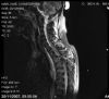 MRI. There is a burst fracture of T4 which shows retropulsed vertebral body fragment and cord transection at T3
