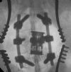 Anterior Corpectomy and vertebral replacement for acute root compression following burst fracture L2
