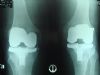 Bilateral Total Kneee Replacement