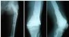 Biologic fixation of Comminuted Fx of Knee & femur