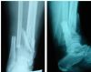 Comminuted and open fracture of distal of tibia and fibula