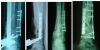 Fixation of Comminuted and open fracture of distal of tibia and fibula in 2 stage (first External fixator of tibia+ plating of fibula and in second stage Plating and bone graft for tibia fracture)