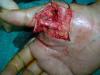 same case, operative findings: separation of the volar plate, intact flexor pulley, cut radial digital nerve of the thumb