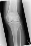Lateral tibia pleateau fracture - AP view (1)